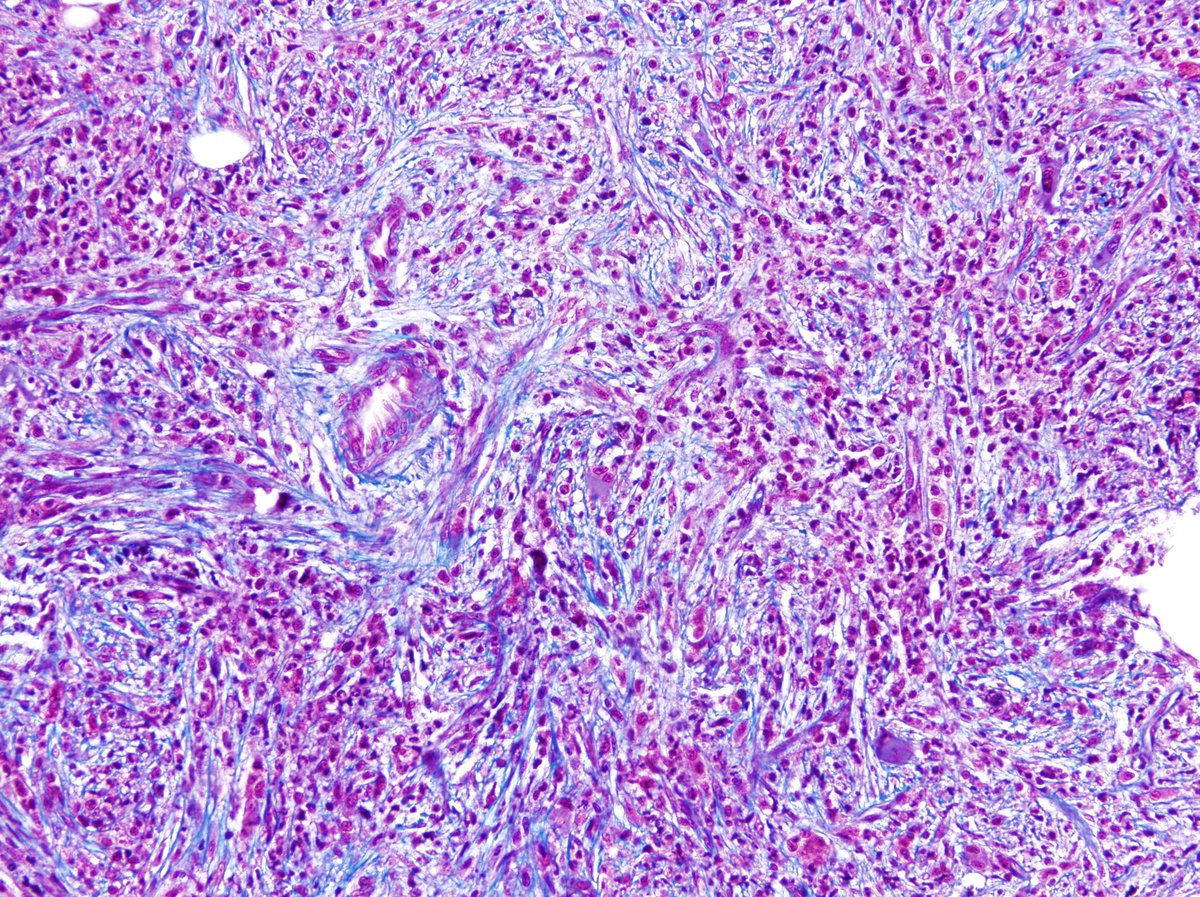 Trichrome stain shows overt collagen fibrosis